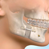 Cirurgia Ortognática