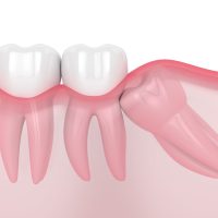 Extração de Dentes