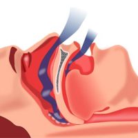 Tratamento de Apneia de Sono
